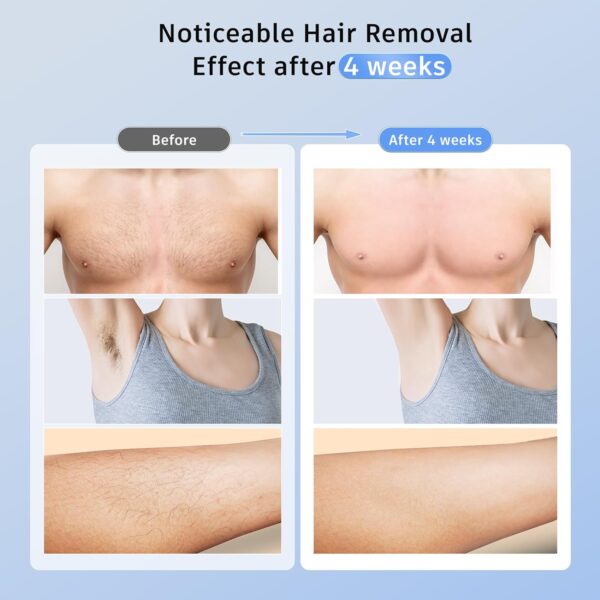 Laser Hair Removal - Image 7